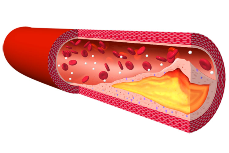 脂質異常症のイメージ