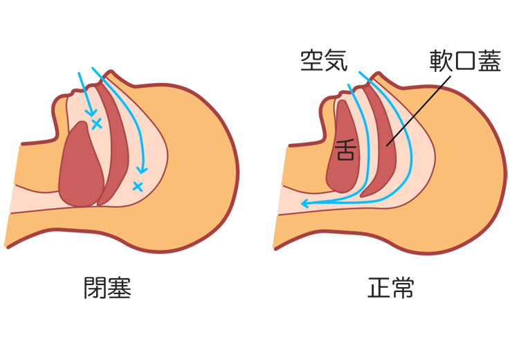 睡眠時無呼吸症候群のイメージ